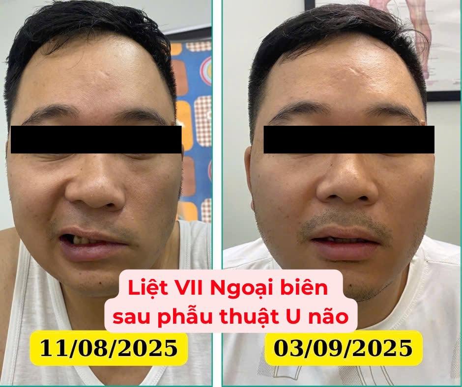 Bệnh nhân trước và sau điều trị liệt dây thần kinh số VII ngoại biên sau phẫu thuật u não, 11/08/2025 và 03/09/2025